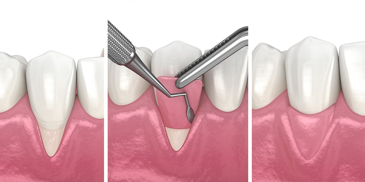 Gum Graft Illustration