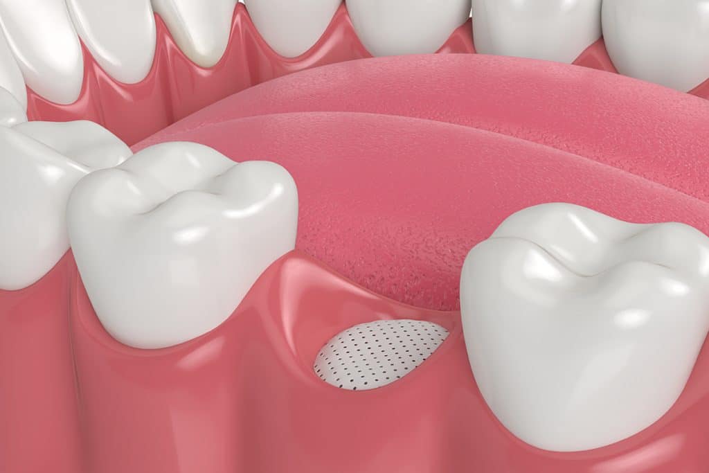 Healing After Bone Graft Surgery: What to Expect in the First Month