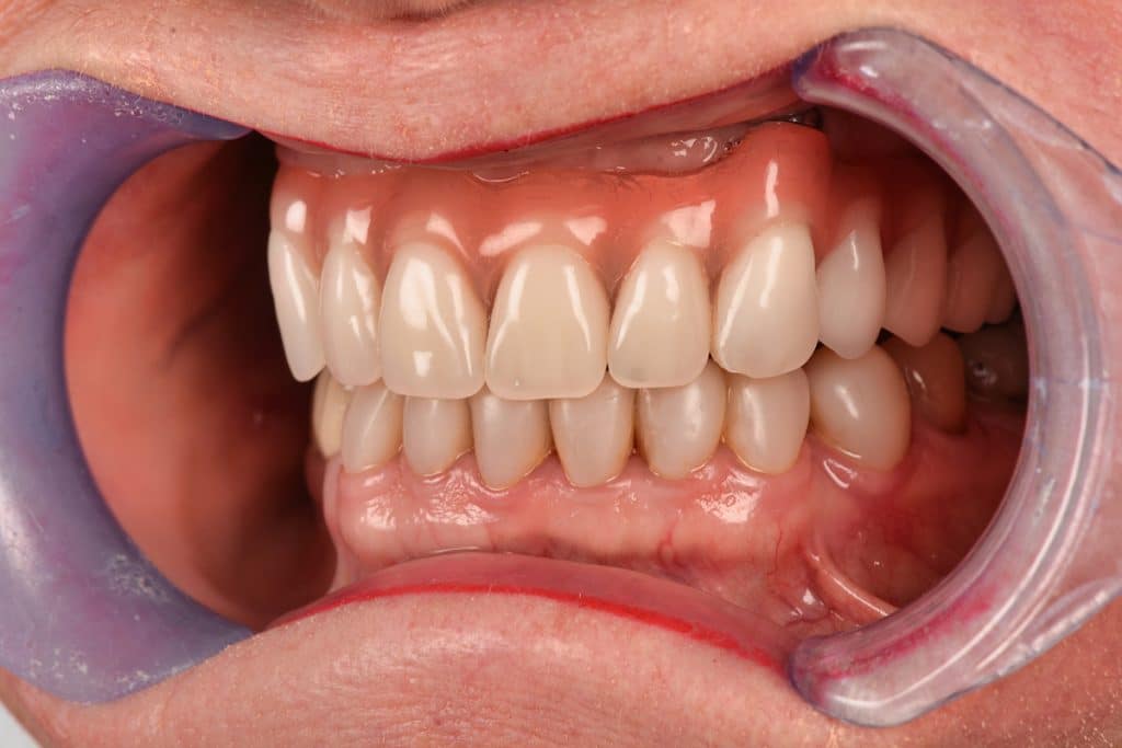 What Is Full Mouth Reconstruction? Here’s What Orange Park Patients Should Know