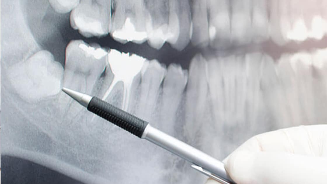 xray showing impacted wisdom teeth